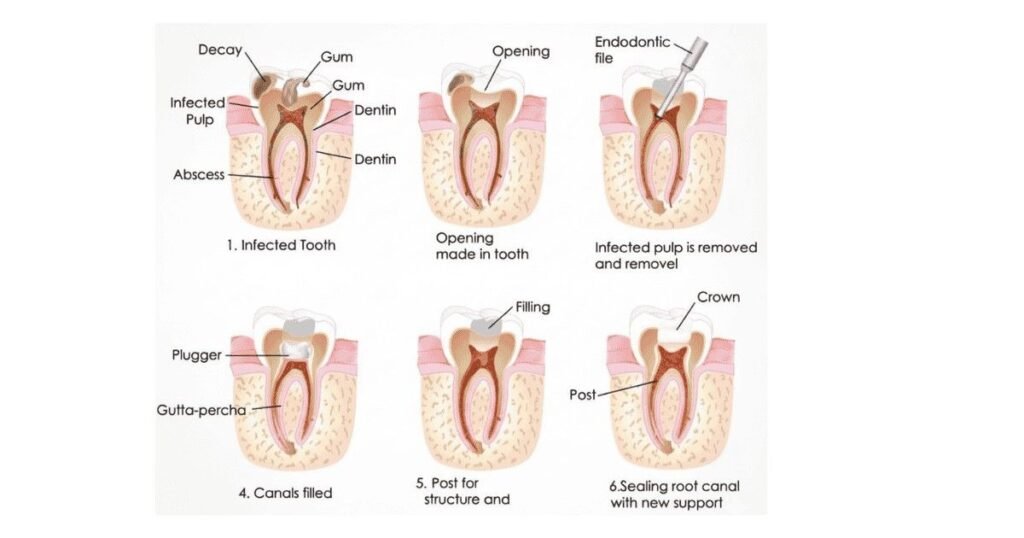 Root Canal Treatment in Iyyappanthangal