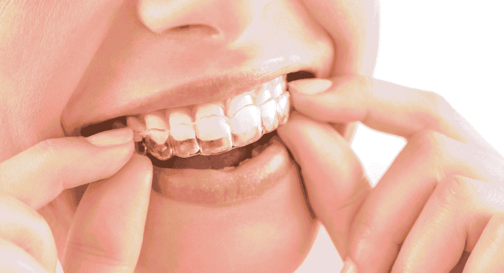 Invisalign Treatment in Iyyappanthangal