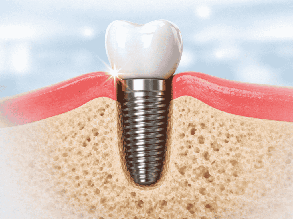 Dental Implants in Iyyappanthangal