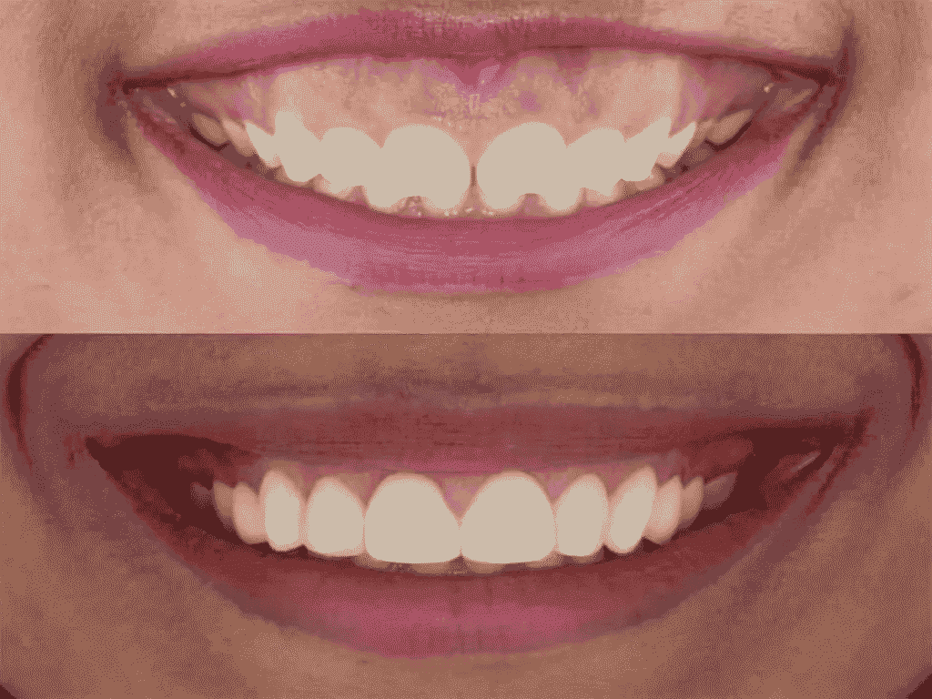 Smile Makeover in Iyyappanthangal