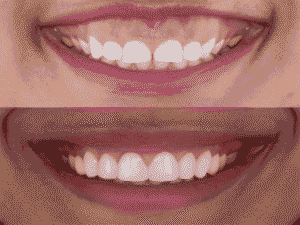 Smile Makeover in Iyyappanthangal