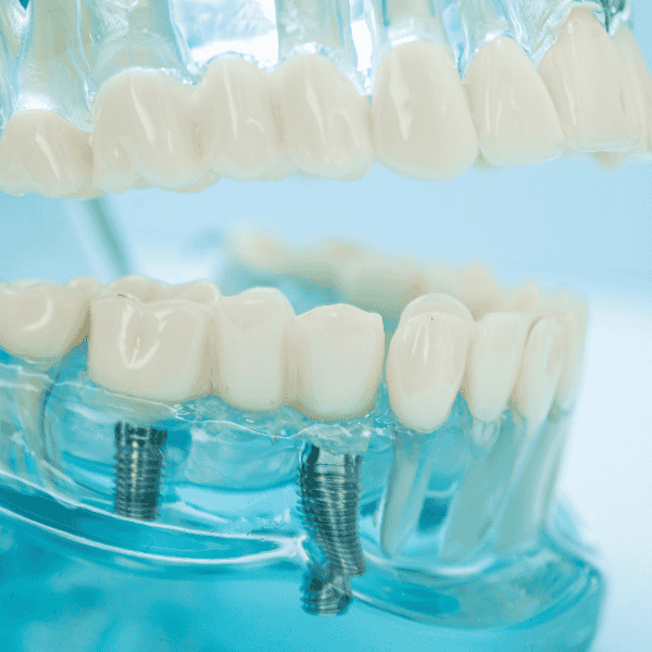 Teeth Replacement Image